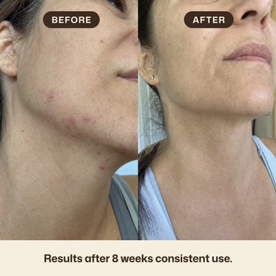 Cyperus rotundus oil for reducing unwanted hair