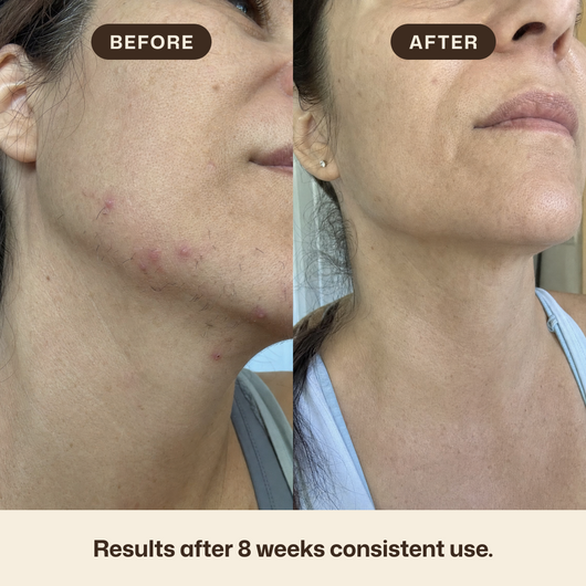 Cyperus rotundus oil for reducing unwanted hair