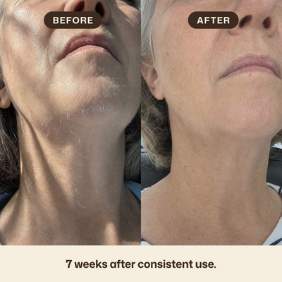 Cyperus rotundus oil for reducing unwanted hair