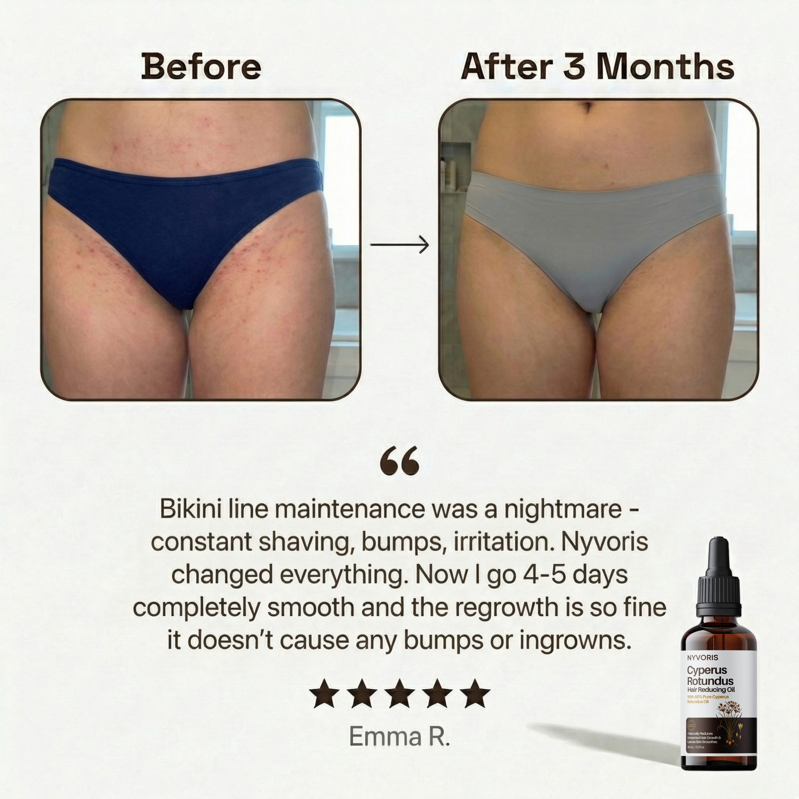 Nyvoris clinically studied against Alexandrite laser — works for PCOS and hormonal hair